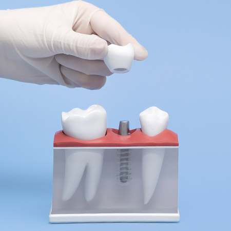 Do I need dental implants?